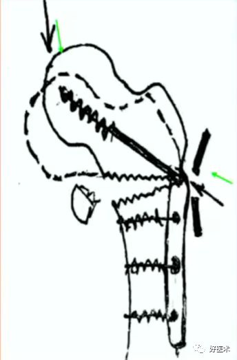 手把手教程：打牢转子间髓内钉，技巧在这！