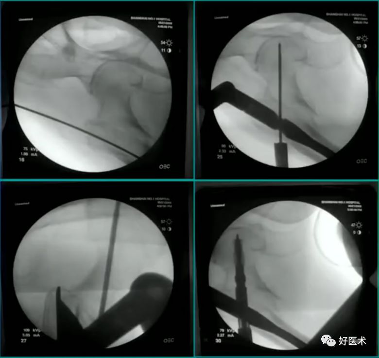 手把手教程：打牢转子间髓内钉，技巧在这！