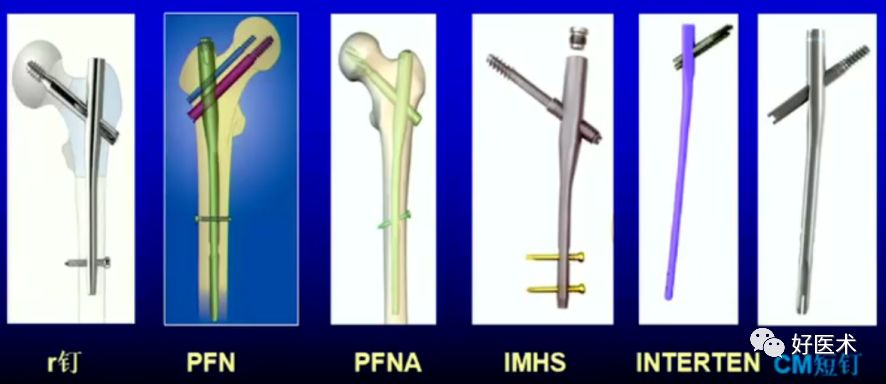 手把手教程：打牢转子间髓内钉，技巧在这！