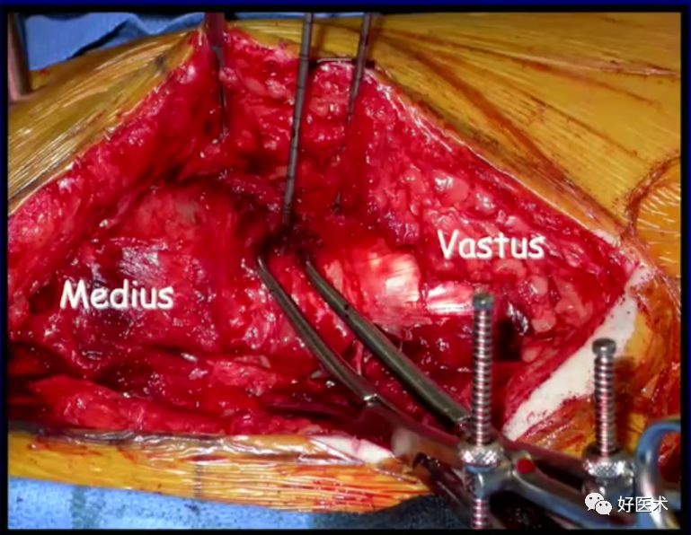 手把手教程：打牢转子间髓内钉，技巧在这！