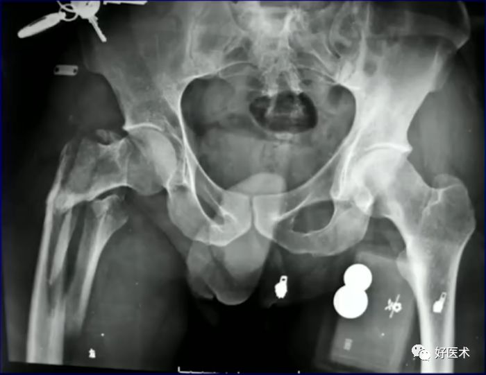 手把手教程：打牢转子间髓内钉，技巧在这！