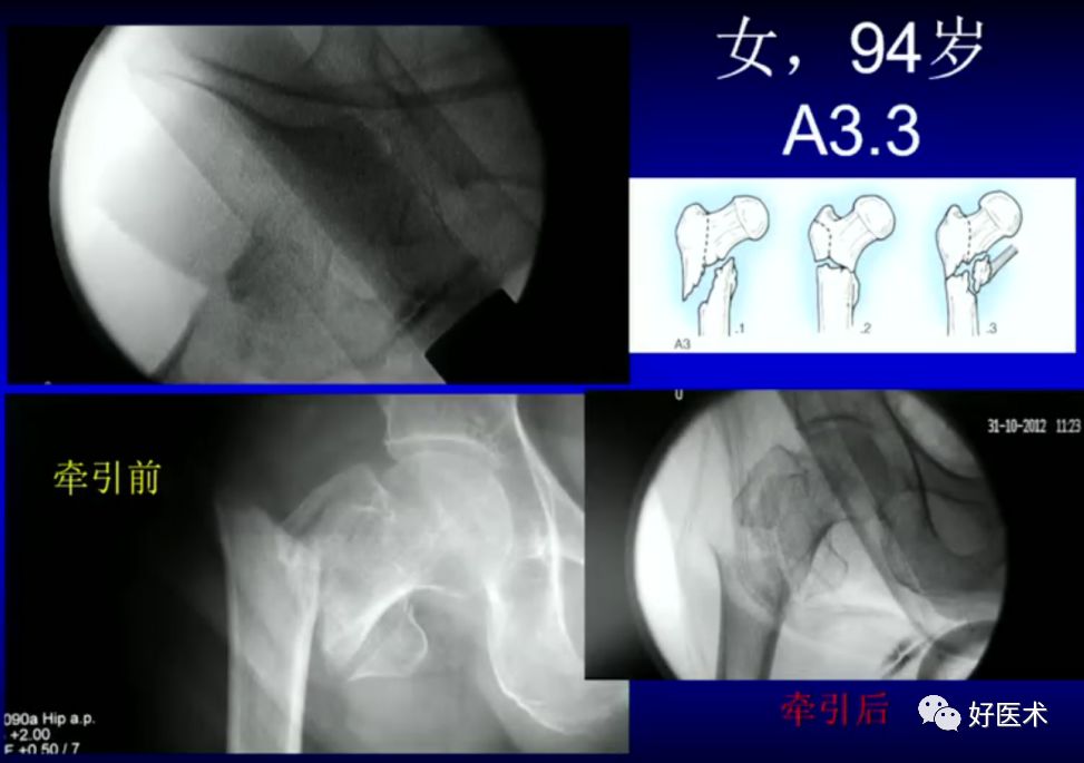 手把手教程：打牢转子间髓内钉，技巧在这！