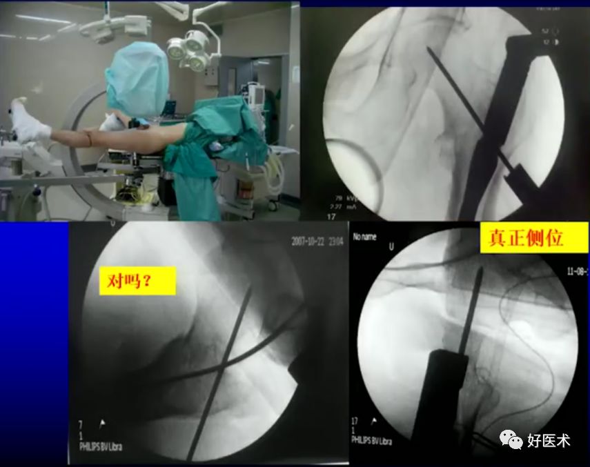 手把手教程：打牢转子间髓内钉，技巧在这！