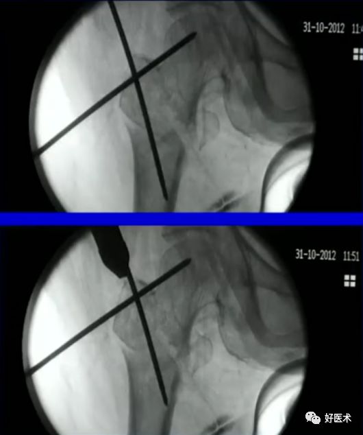 手把手教程：打牢转子间髓内钉，技巧在这！