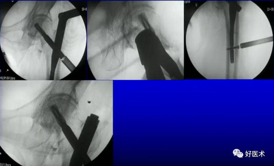 手把手教程：打牢转子间髓内钉，技巧在这！