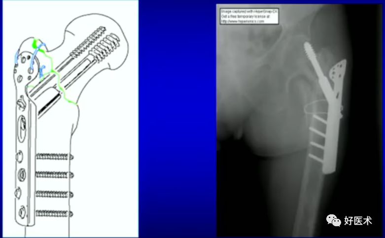 手把手教程：打牢转子间髓内钉，技巧在这！