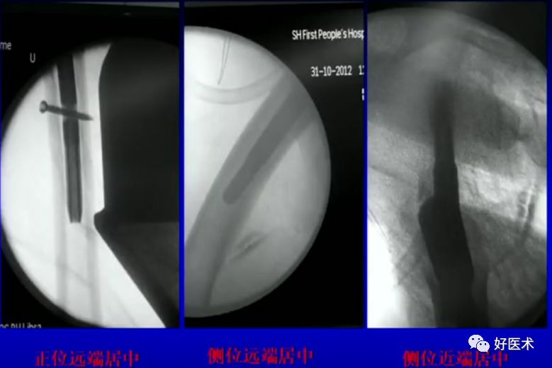手把手教程：打牢转子间髓内钉，技巧在这！