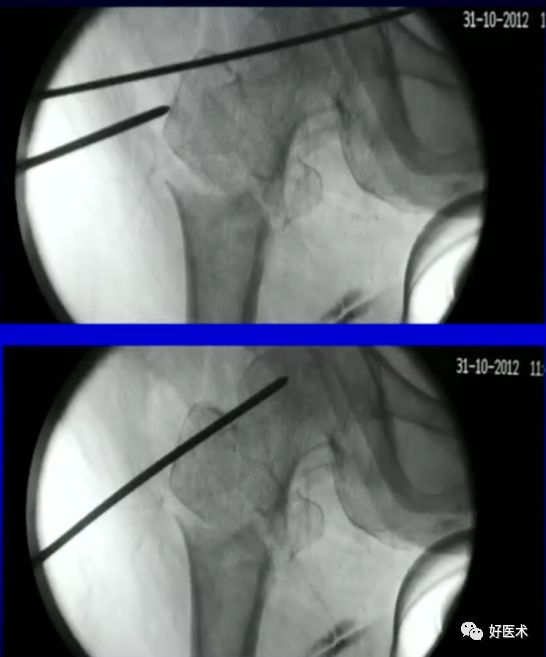 手把手教程：打牢转子间髓内钉，技巧在这！