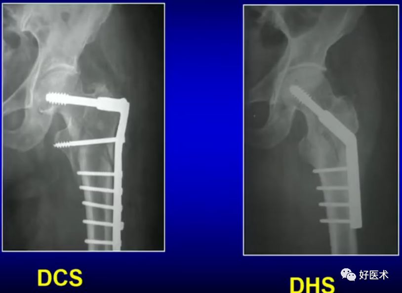 手把手教程：打牢转子间髓内钉，技巧在这！