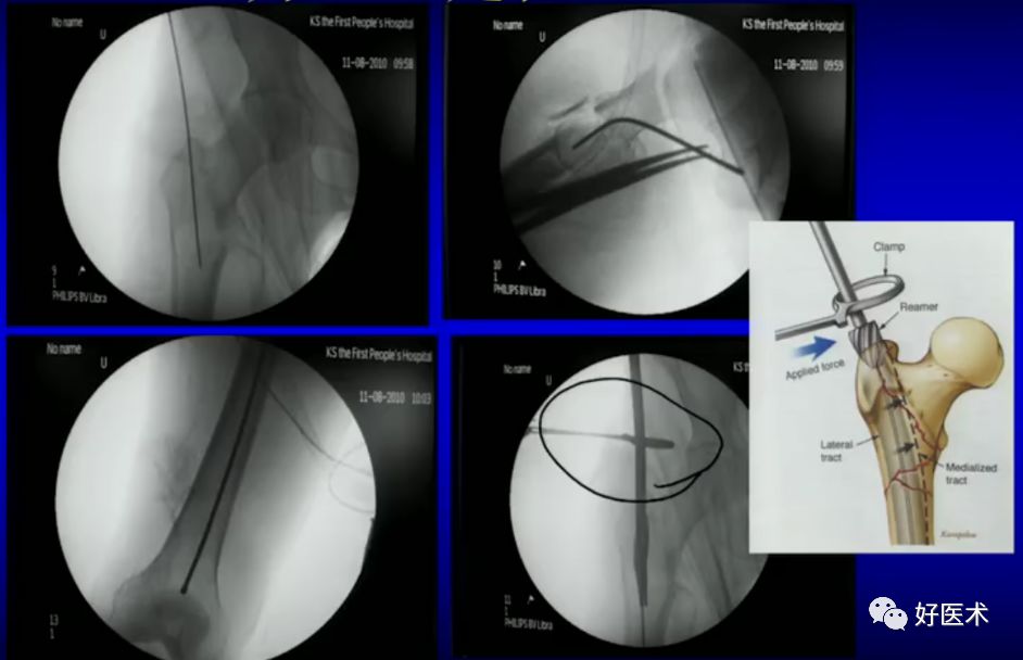 手把手教程：打牢转子间髓内钉，技巧在这！