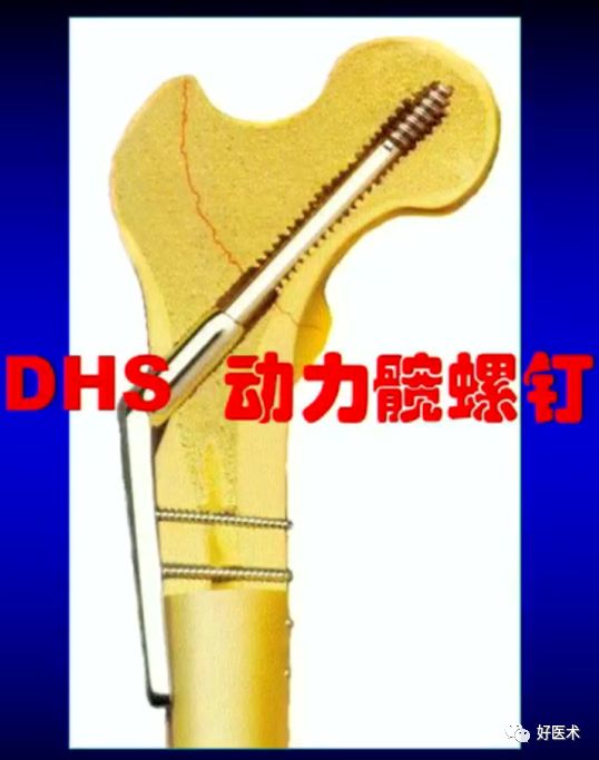 手把手教程：打牢转子间髓内钉，技巧在这！