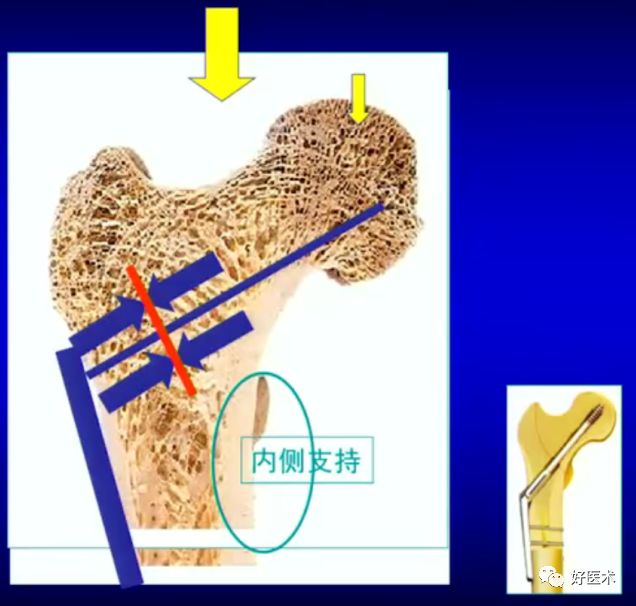 手把手教程：打牢转子间髓内钉，技巧在这！