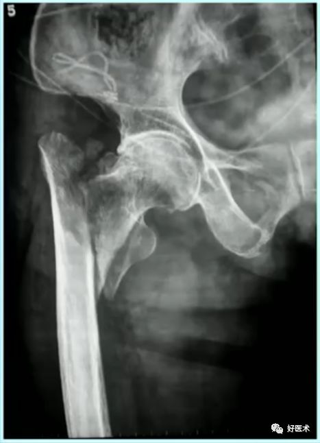 手把手教程：打牢转子间髓内钉，技巧在这！