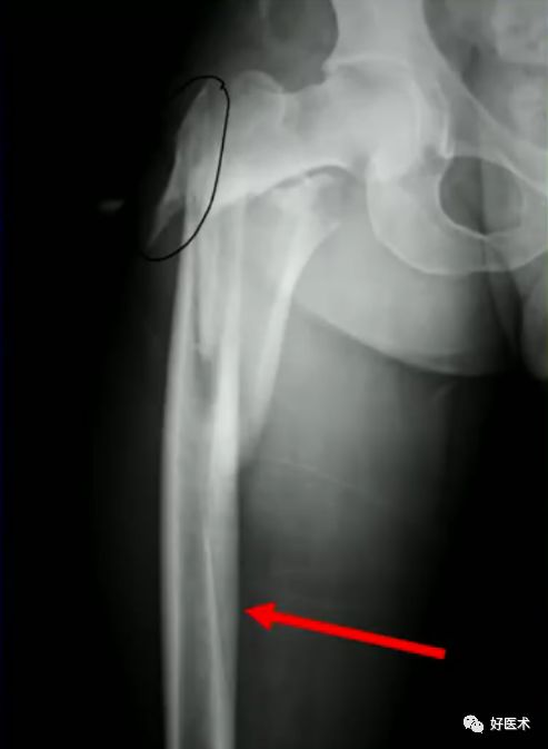 手把手教程：打牢转子间髓内钉，技巧在这！