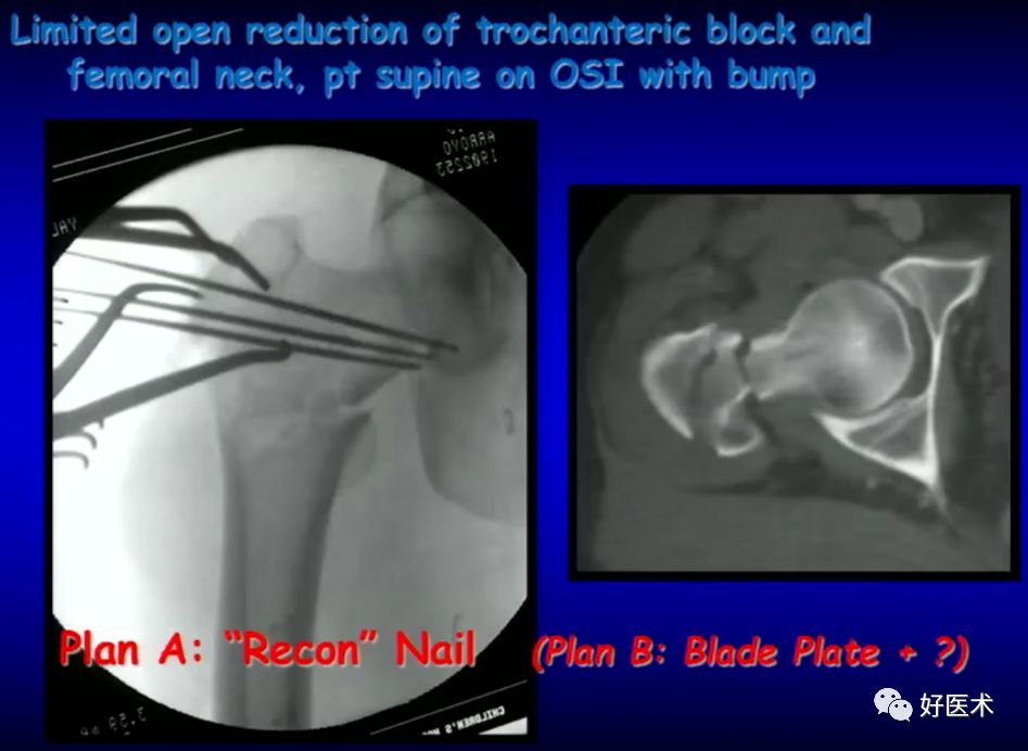 手把手教程：打牢转子间髓内钉，技巧在这！