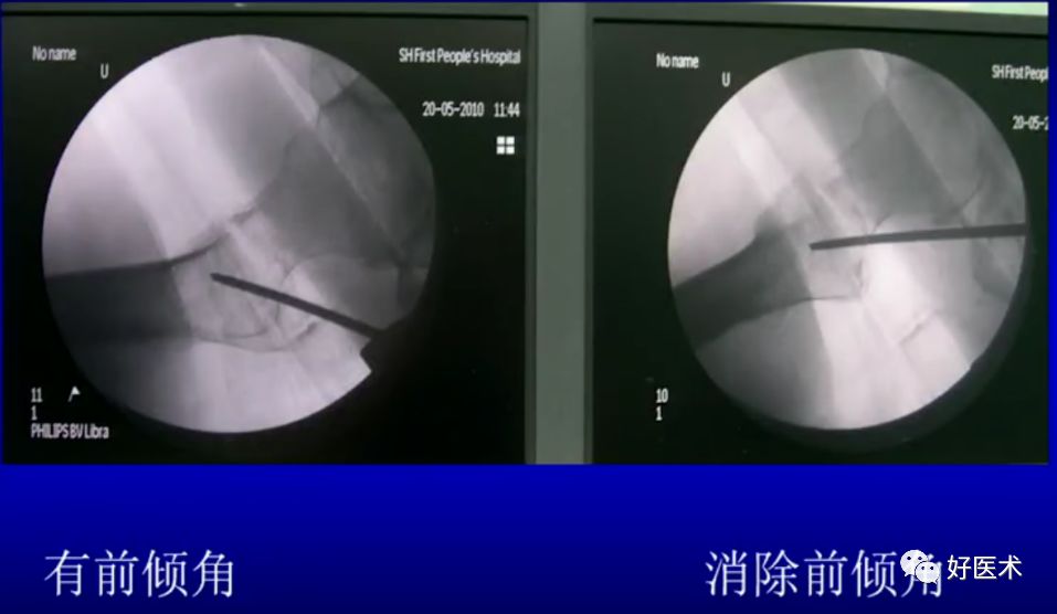 手把手教程：打牢转子间髓内钉，技巧在这！