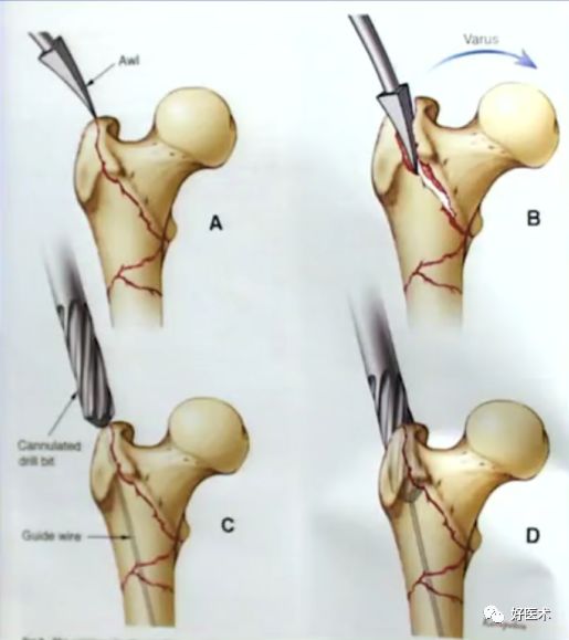 手把手教程：打牢转子间髓内钉，技巧在这！
