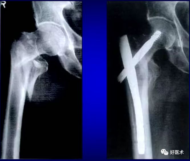 手把手教程：打牢转子间髓内钉，技巧在这！