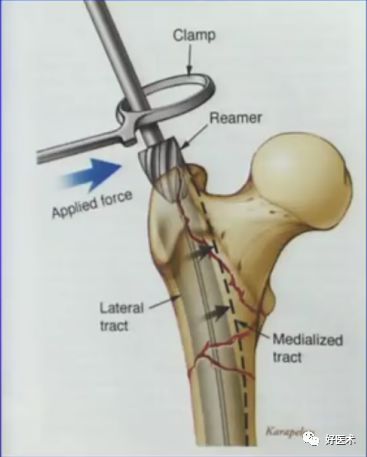 手把手教程：打牢转子间髓内钉，技巧在这！