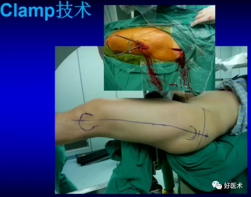 手把手教程：打牢转子间髓内钉，技巧在这！