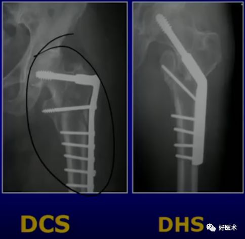 手把手教程：打牢转子间髓内钉，技巧在这！