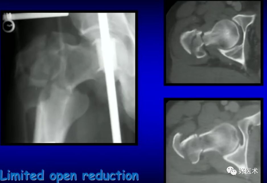 手把手教程：打牢转子间髓内钉，技巧在这！