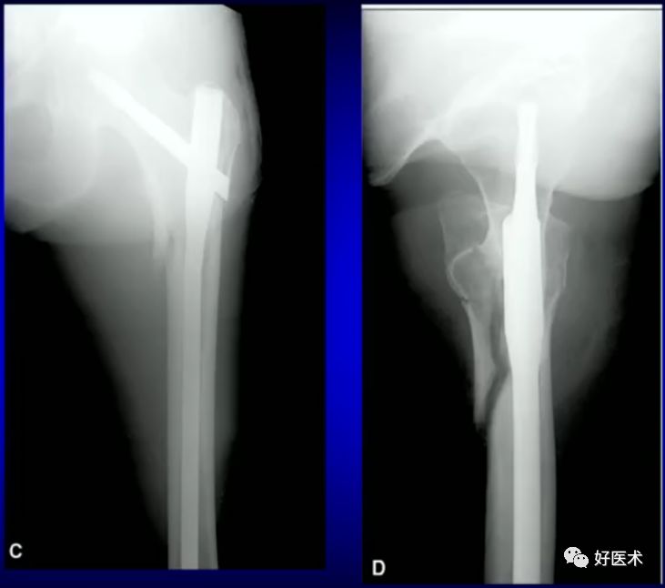手把手教程：打牢转子间髓内钉，技巧在这！