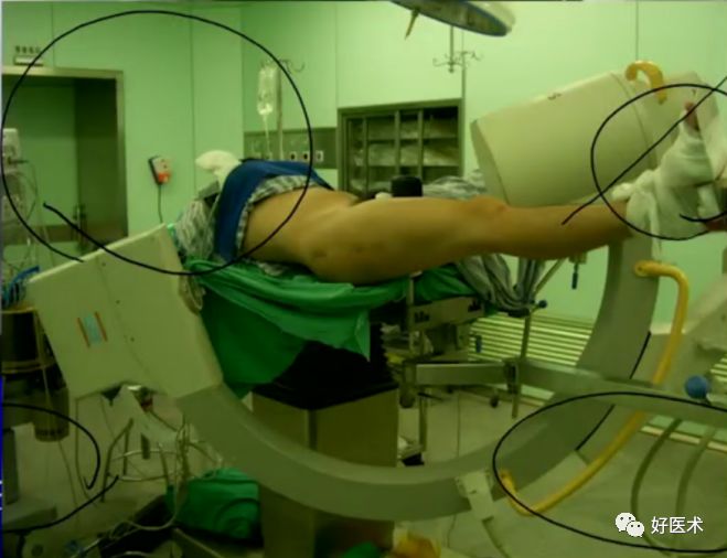 手把手教程：打牢转子间髓内钉，技巧在这！