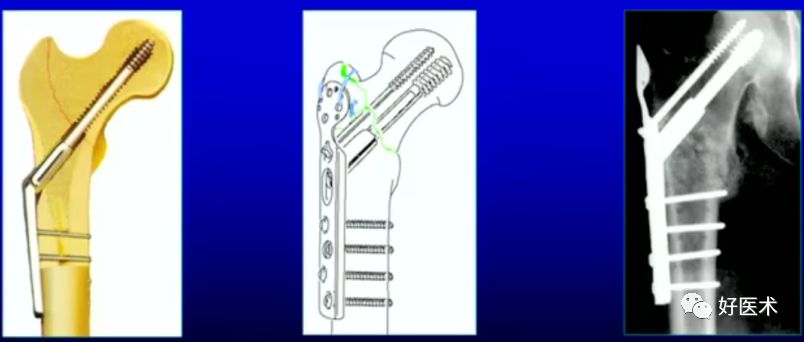 手把手教程：打牢转子间髓内钉，技巧在这！