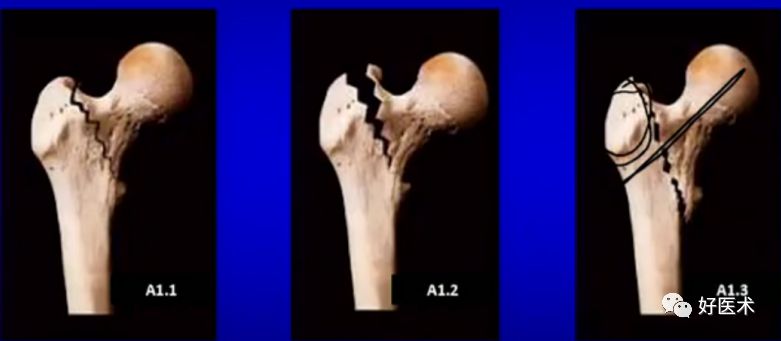 手把手教程：打牢转子间髓内钉，技巧在这！