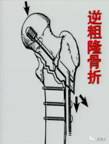 手把手教程：打牢转子间髓内钉，技巧在这！