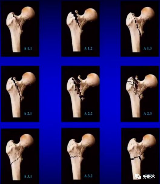 手把手教程：打牢转子间髓内钉，技巧在这！