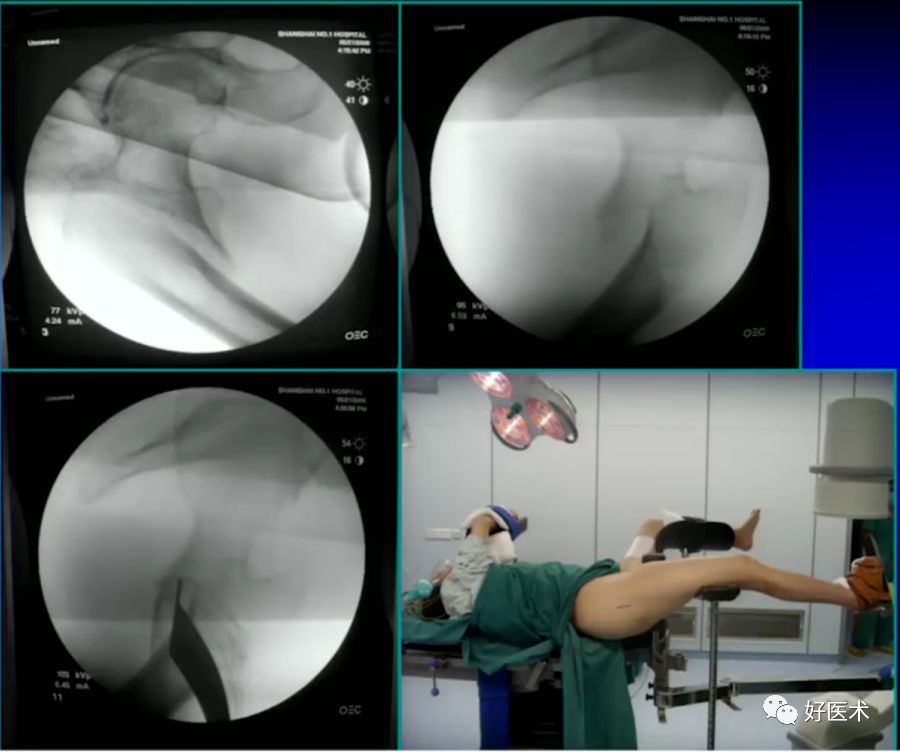 手把手教程：打牢转子间髓内钉，技巧在这！