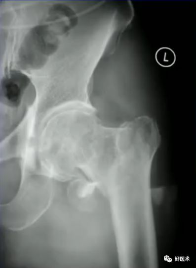 手把手教程：打牢转子间髓内钉，技巧在这！