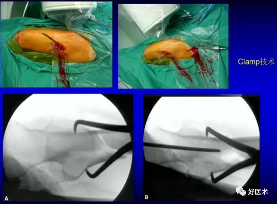 手把手教程：打牢转子间髓内钉，技巧在这！