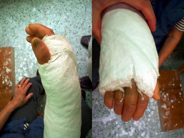 骨折后石膏外固定技术详解_医学界-助力医生临床决策和职业成长