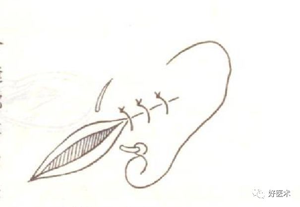 缝线怎么打结外科手术操作 ｜ 打开手术通路之缝合打结_https://www.jmylbn.com_新闻资讯_第1张