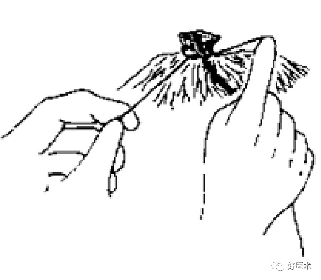 缝线怎么打结外科手术操作 ｜ 打开手术通路之缝合打结_https://www.jmylbn.com_新闻资讯_第24张