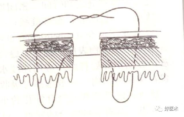 缝线怎么打结外科手术操作 ｜ 打开手术通路之缝合打结_https://www.jmylbn.com_新闻资讯_第6张