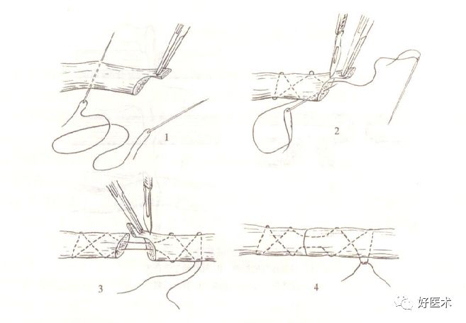 缝线怎么打结外科手术操作 ｜ 打开手术通路之缝合打结_https://www.jmylbn.com_新闻资讯_第14张