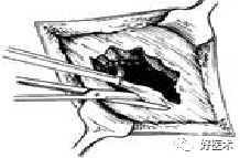 分离结扎钳怎么用【学生频道】外科手术基本功速成法，书上学不到的秘诀！（聂邯洛医师推荐）_https://www.jmylbn.com_新闻资讯_第65张