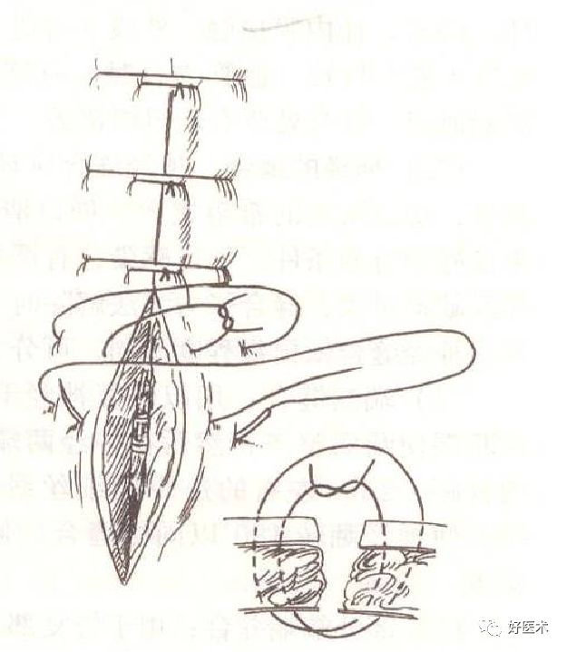 缝线怎么打结外科手术操作 ｜ 打开手术通路之缝合打结_https://www.jmylbn.com_新闻资讯_第13张