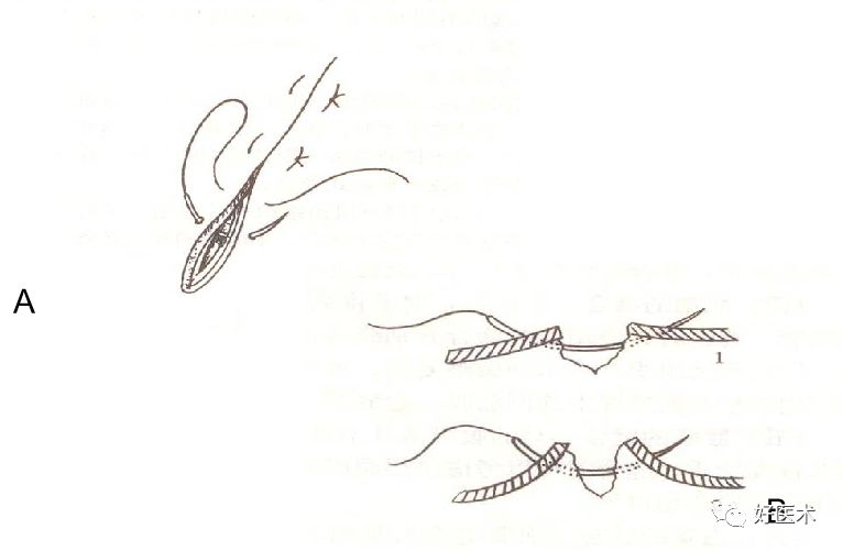 缝线怎么打结外科手术操作 ｜ 打开手术通路之缝合打结_https://www.jmylbn.com_新闻资讯_第2张