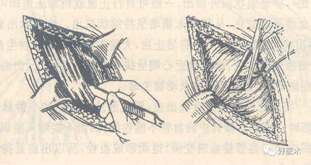 分离结扎钳怎么用【学生频道】外科手术基本功速成法，书上学不到的秘诀！（聂邯洛医师推荐）_https://www.jmylbn.com_新闻资讯_第32张