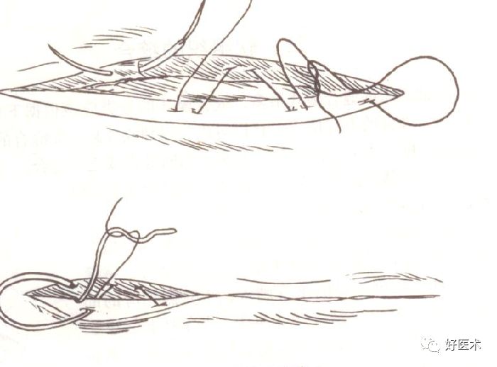 缝线怎么打结外科手术操作 ｜ 打开手术通路之缝合打结_https://www.jmylbn.com_新闻资讯_第8张