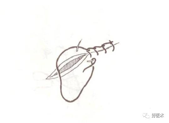 缝线怎么打结外科手术操作 ｜ 打开手术通路之缝合打结_https://www.jmylbn.com_新闻资讯_第12张