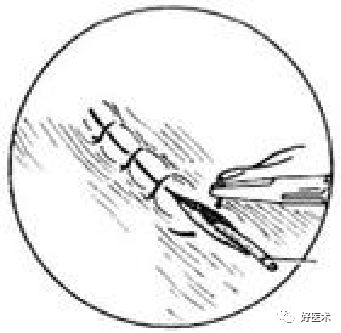 分离结扎钳怎么用【学生频道】外科手术基本功速成法，书上学不到的秘诀！（聂邯洛医师推荐）_https://www.jmylbn.com_新闻资讯_第66张