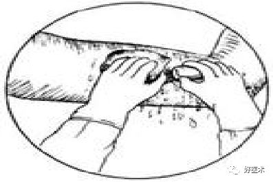 分离结扎钳怎么用【学生频道】外科手术基本功速成法，书上学不到的秘诀！（聂邯洛医师推荐）_https://www.jmylbn.com_新闻资讯_第62张