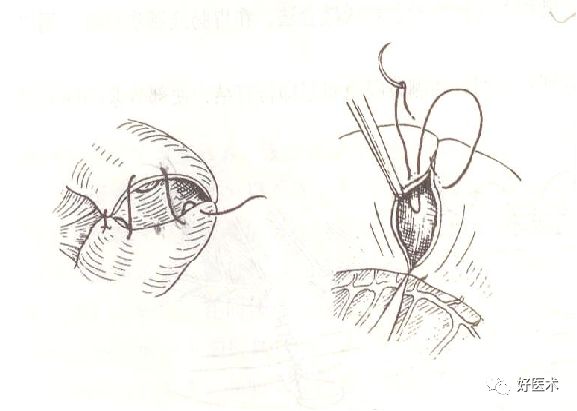 缝线怎么打结外科手术操作 ｜ 打开手术通路之缝合打结_https://www.jmylbn.com_新闻资讯_第11张