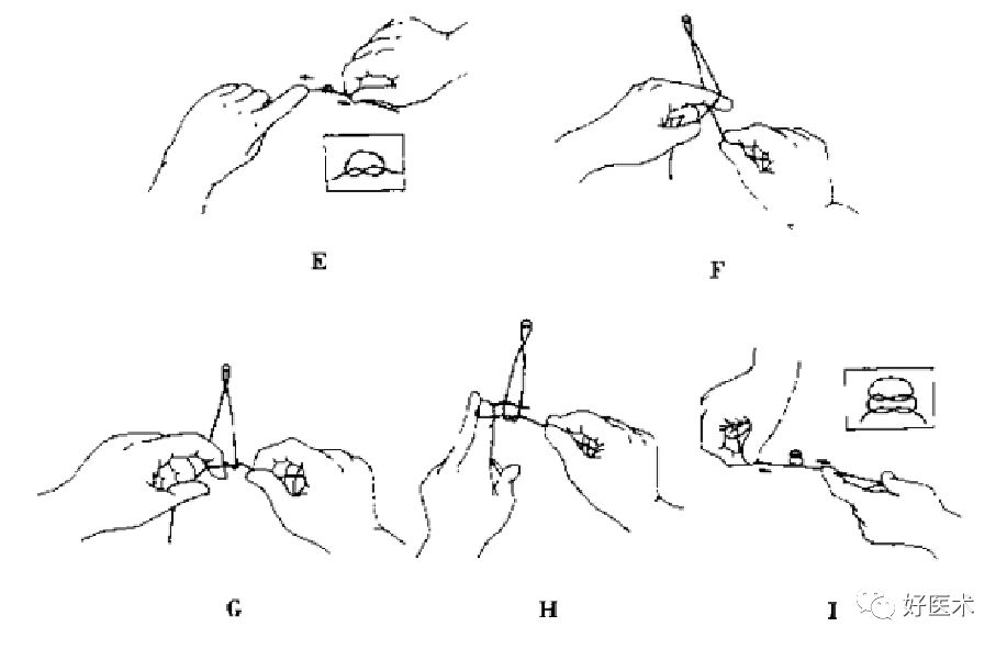 缝线怎么打结外科手术操作 ｜ 打开手术通路之缝合打结_https://www.jmylbn.com_新闻资讯_第21张